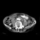 Cholecystolithiasis: CT - Computed tomography